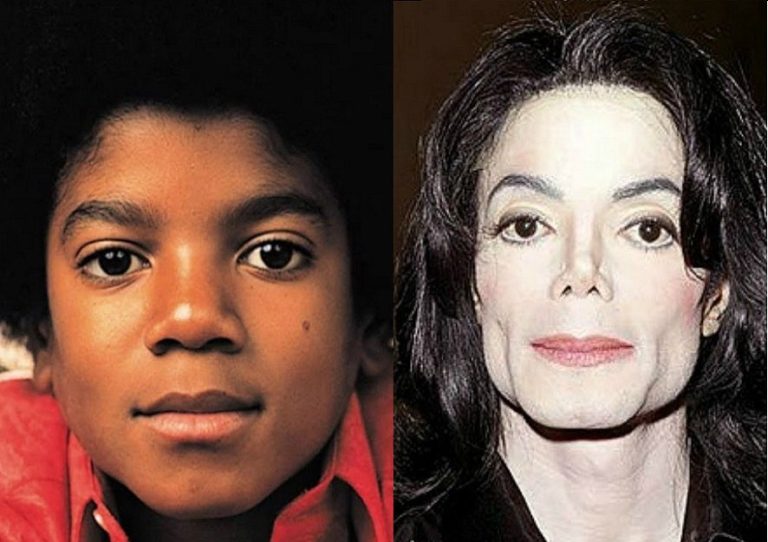 How Michael Jackson struggled with vitiligo and turned white