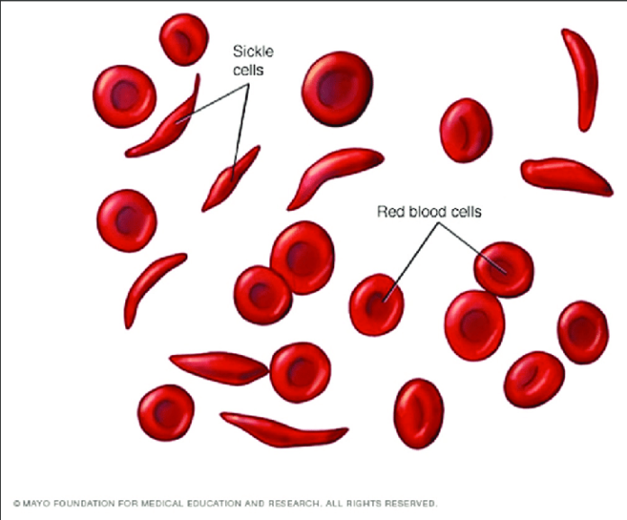 FDA Approves Revolutionary Cell-Based Gene Therapies for Sickle Cell ...