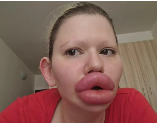 See what woman with the ‘World’s largest lips’ looked like before she spent $26,000