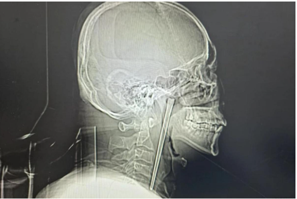 Chinese Drunkard spent 8 years with metal chopstick stuck in his throat