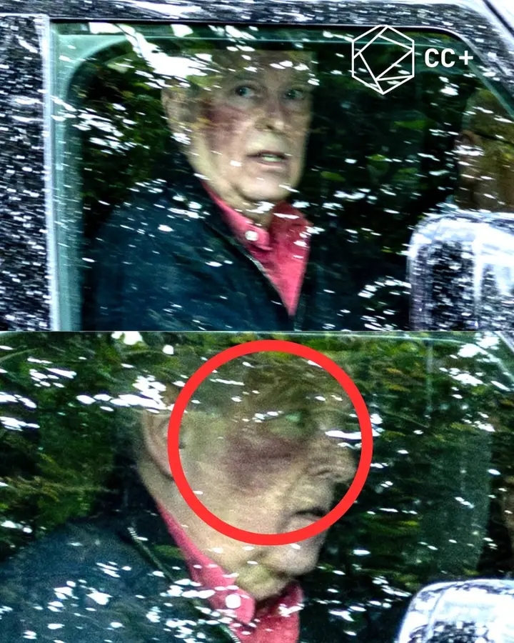 Former Prince Andrew was spotted with a large purple bruise covering part of the right side of his face